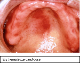 Erythemateuze-candidose.png