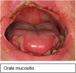 Orale-mucositis-(1).png Orale-mucositis-(1).png