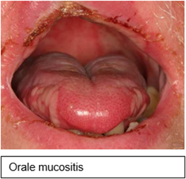 Orale-mucositis-(1).png