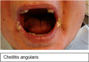 Cheilitis-angularis.png